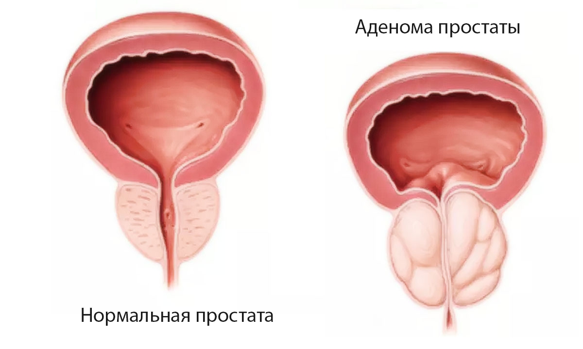 kalcifikacijos prostatos erekcijoje stipri erekcija naktį