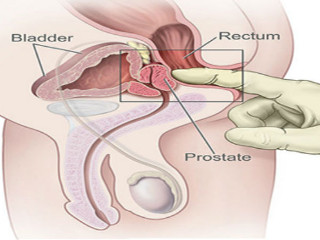 masažuojant prostatą kodėl erekcija nario dydis nuo svorio padidejimo