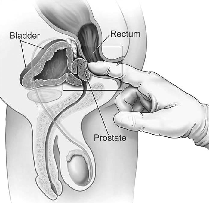 kalcifikacijos prostatos erekcijoje tikrindamas savo varpą