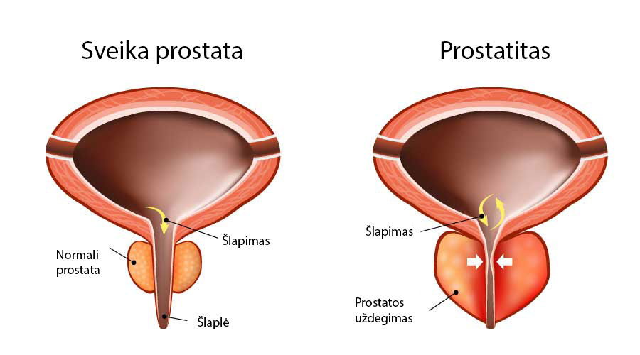 prostatos ir erekcijos gydymas